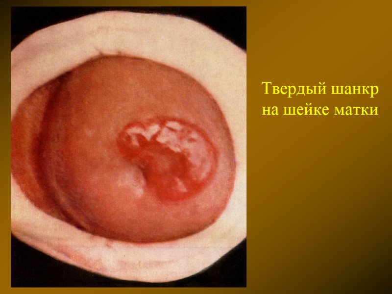 Твердый шанкр на шейке матки